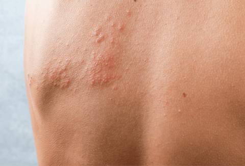 Shingles on the back